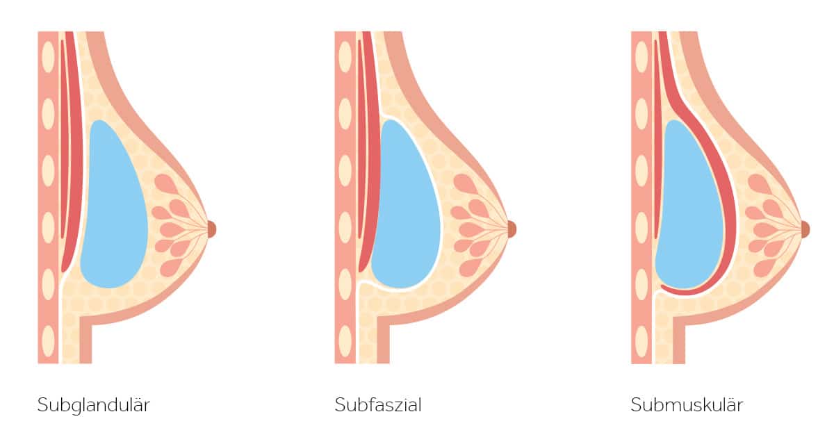 Was Sie über Brustimplantate <br/>wissen müssen